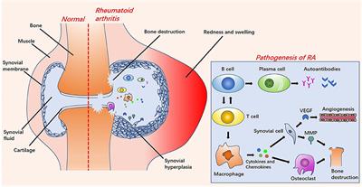 Energy Conversion-Based Nanotherapy for Rheumatoid Arthritis Treatment